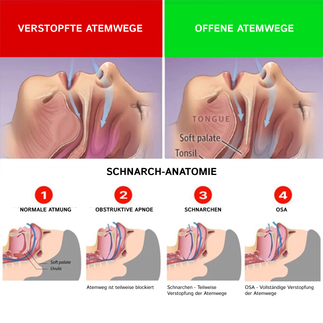 Quietmex Anti Schnarchschiene