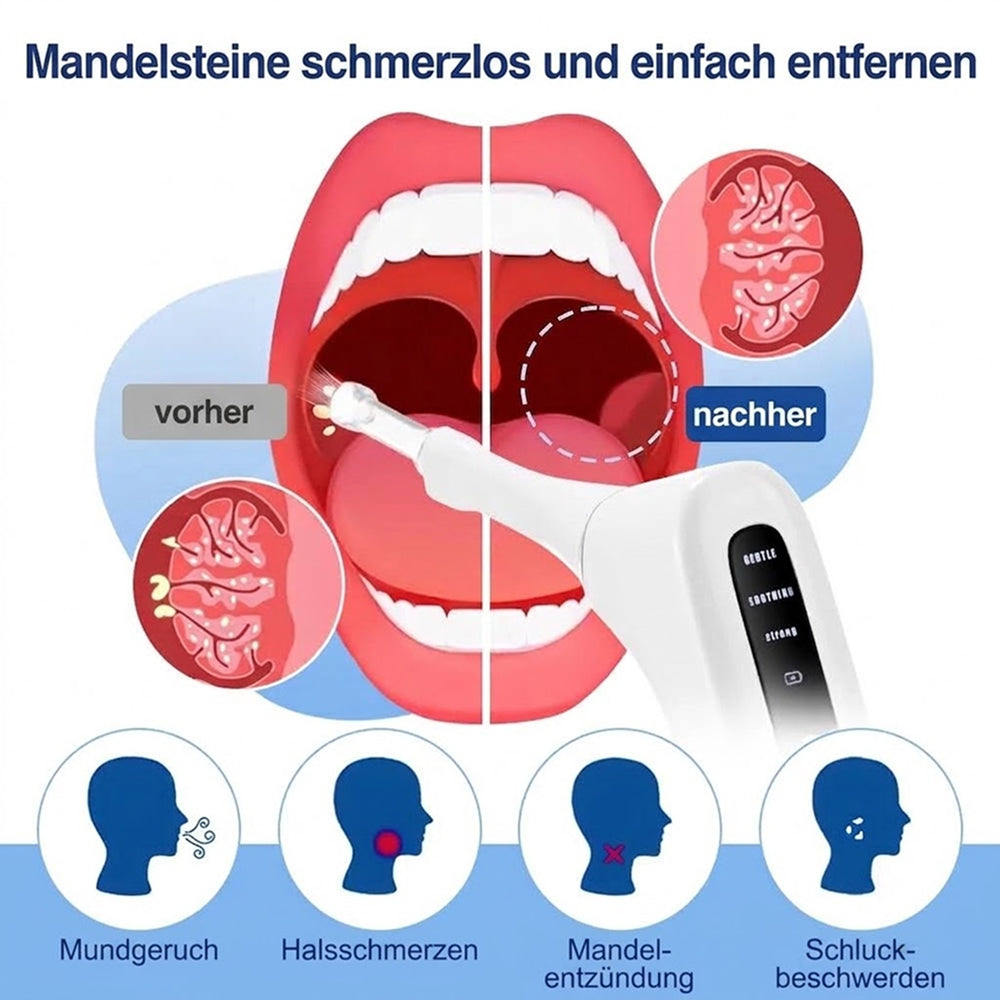 Tonsimox Mandelstein Entferner